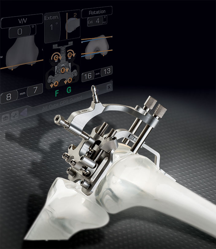 image of AdvitaGPS in background with rendering of knee being operated on using AdvitaGPS for Knee