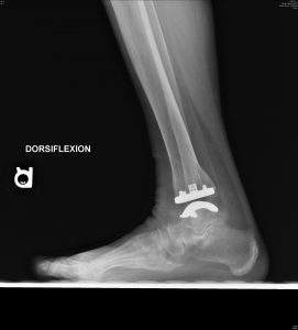 Figure 8. Unique to the Vantage fixed-bearing total ankle system is the locking clip technology that secures the polyethylene to the tibial tray.