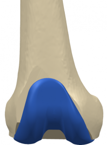 Figure 3. A representative femur (Chinese, female) with the placement of the Truliant femoral component. No clinically important overhang (> 3mm) was observed on this bone.