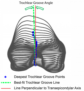 Figure 3. A representative femur demonstrating the calculation of the orientation of the trochlear groove. A negative trochlear groove angle indicates that the groove was oriented laterally from distal to proximal direction, as illustrated to the left.