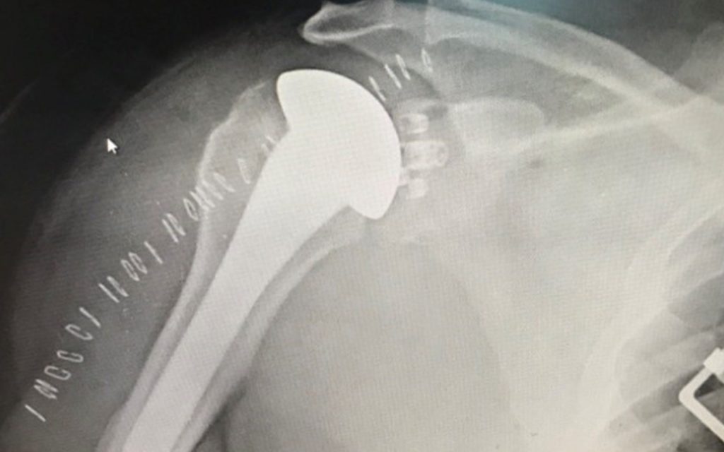 Shoulder Revision with a Platform System