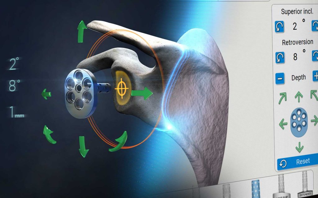 AdvitaGPS and Equinoxe Shoulder System