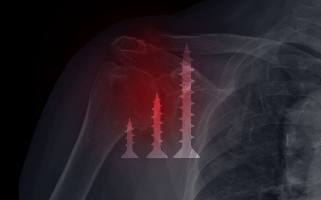 Screw Length vs Quantity in rTSA