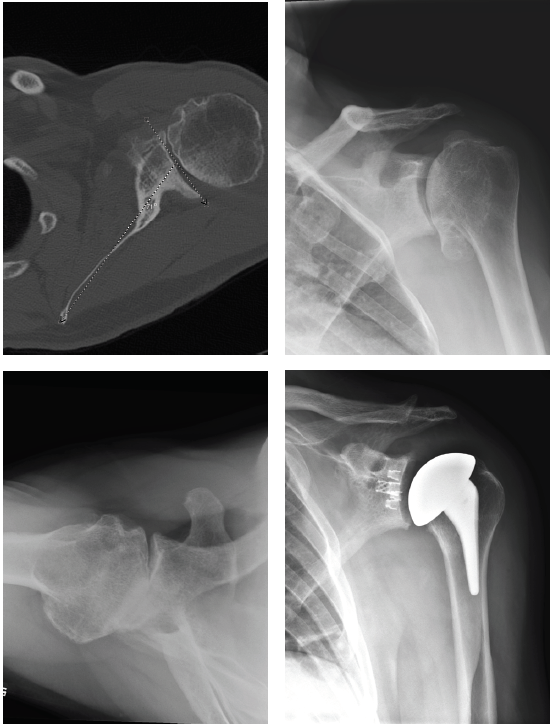 “With the advent of shorter stems, I have come to analyze my longer-term follow-up with more scrutiny, and thusly now select shorter stems more frequently, bone quality permitting, due to concerns of proximal stress shielding of the tuberosities. Though I am not sure what length of the shorter style stem is the best choice, I believe the stemless [implants] will be incorporated far more frequently whenever the bone is good enough. I have been able to continue to use an LTO (lesser tuberosity osteotomy) on these cases. Lately, I have only used the standard length stem with significant osteopenia proximally.” Patient 1: Primary anatomic total shoulder arthroplasty using Equinoxe Preserve short stem and caged glenoid. Active male in his 60s, retired reporter with surprisingly good preop motion This patient is a good candidate for either a stemless anatomic or a short stem anatomic Six (6) weeks postop his external rotation (ER) has returned to preop baseline of 45 degrees and his forward flexion (FF) has improved from 90 to 145 degrees. Patient 2: Primary anatomic total shoulder arthroplasty using a stemless implant. Active male in his 60s, retired radiologist Typical pain and significant range of motion limitations Patient 3: Revision of a failed anatomic total shoulder with loose humeral stem to reverse total shoulder arthroplasty The humeral stem was loose, so it was replaced with the short stem for the aggressive proximal geometry, which fit nicely and improved the proximal press-fit Revised an anatomic to a reverse, replacing stem from another company Significant glenoid wear led to augmented baseplate choice – superior posterior augment Patient 1: 59-year-old male with avascular necrosis of the humeral head. Left primary anatomic total shoulder arthroplasty using Equinoxe Preserve short stem and cage glenoid. Patient 3: 74-year-old female with cuff tear arthropathy. Right primary reverse shoulder arthroplasty with augmented baseplate to treat glenoid wear. Patient 4: 63-year old male with osteoarthritis. Left primary anatomic total shoulder arthroplasty using Equinoxe Preserve short stem with 8-degree cage glenoid.