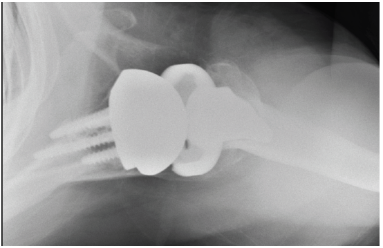 Patient 3: 74-year-old female with cuff tear arthropathy. Right primary reverse shoulder arthroplasty with augmented baseplate to treat glenoid wear.