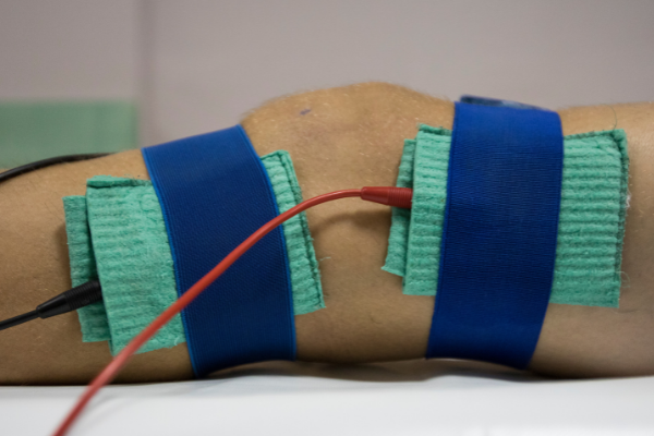 Image is of patient's knee after having ACL surgery using TenoMend and PRP