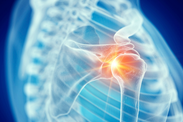 The image points out the glenoid part of the shoulder construct where superior glenoid wear can occur.