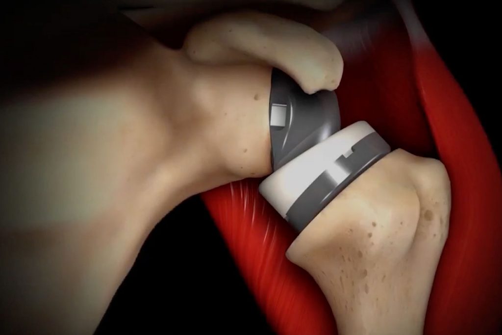 Reverse Shoulder Arthroplasty With and Without Baseplate Wedge Augmentation in the Setting of Glenoid Deformity and Rotator Cuff Deficiency