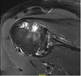 Shoulder Preoperative planning Xray