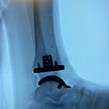 Advita Ankle X-ray of the Vantage Ankle 3D+ implant from a lateral view.