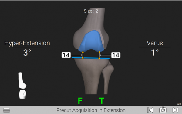 Advita Knee Newton GPS Technology for TKA