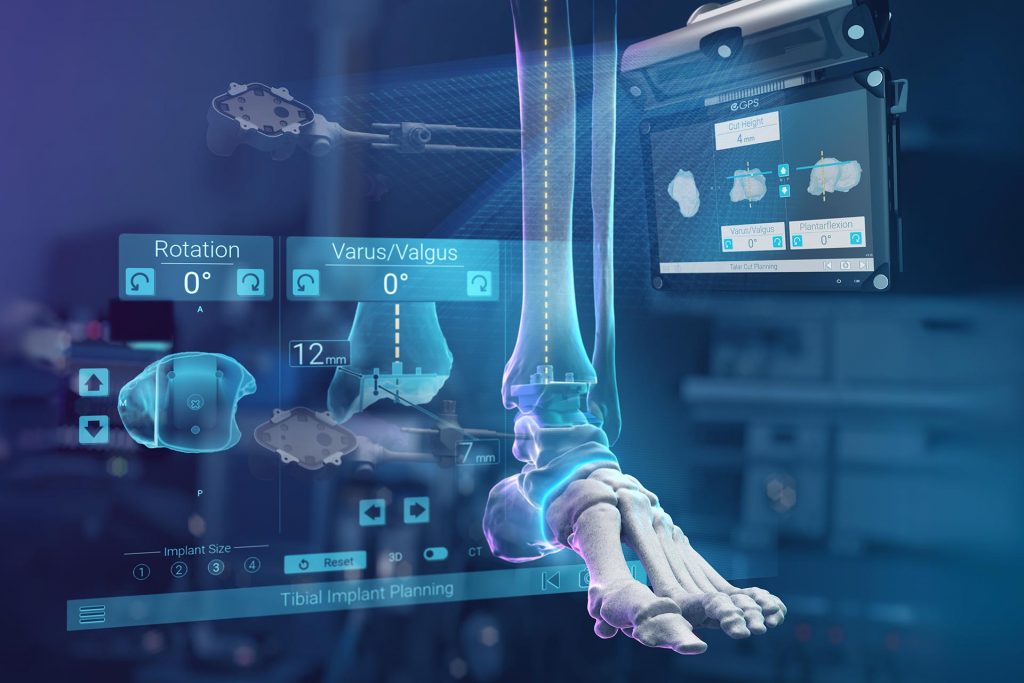 GPS Ankle Navigation in Total Ankle Arthroplasty with Vantage Total Ankle