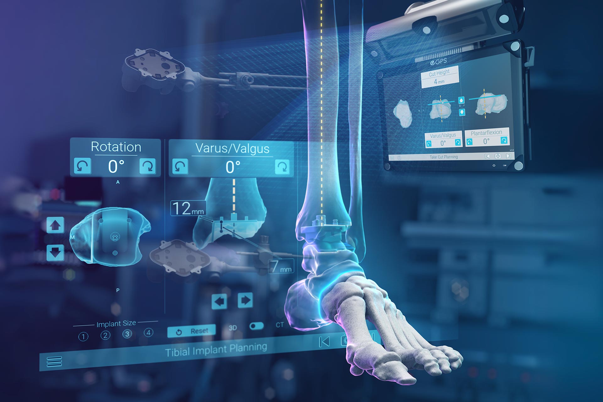 GPS Ankle Navigation in Total Ankle Arthroplasty with Vantage Total Ankle