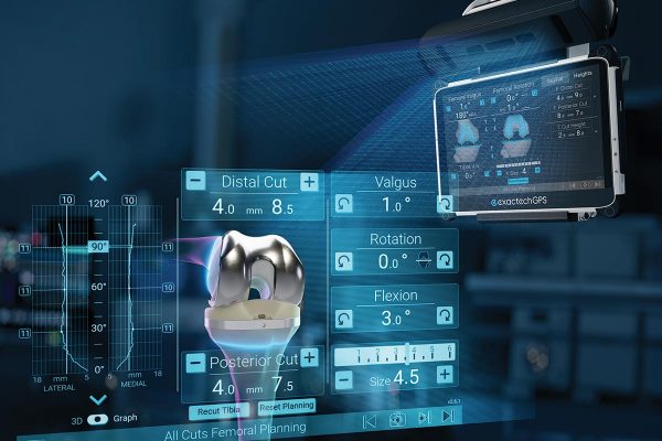 Advita Knee Balancing with GPS