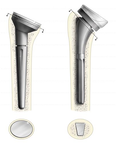 Shoulder Stem Comparison Illustration