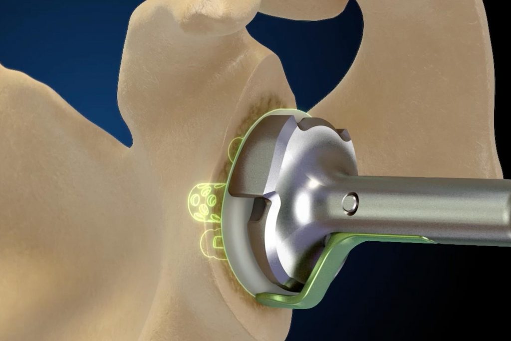 Computer Navigation in Shoulder Arthroplasty