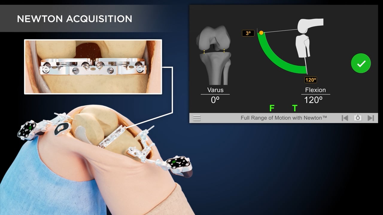 GPS Knee Animation: Newton Balancing Technology