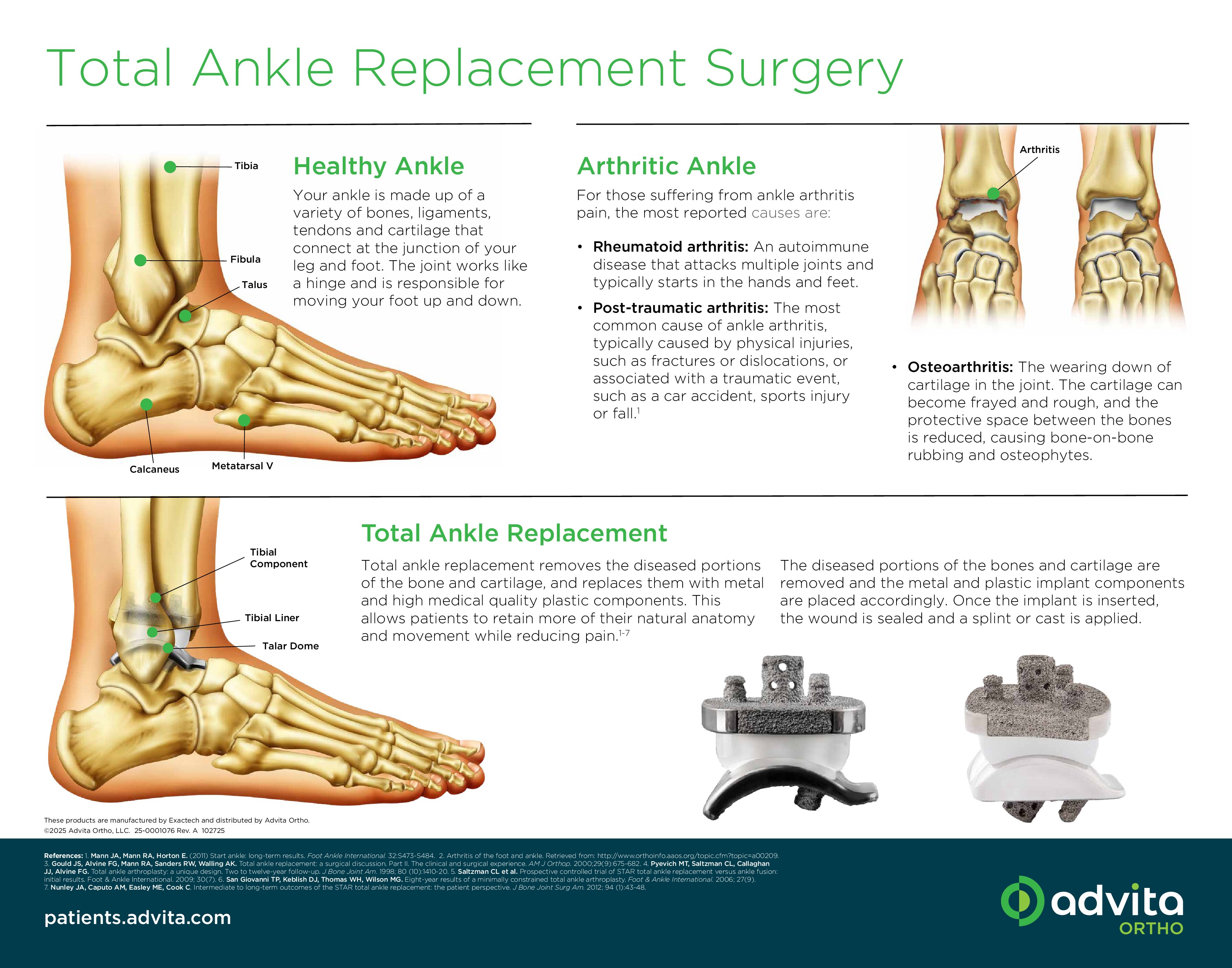 Vantage Ankle Patient Education Exam Room Poster