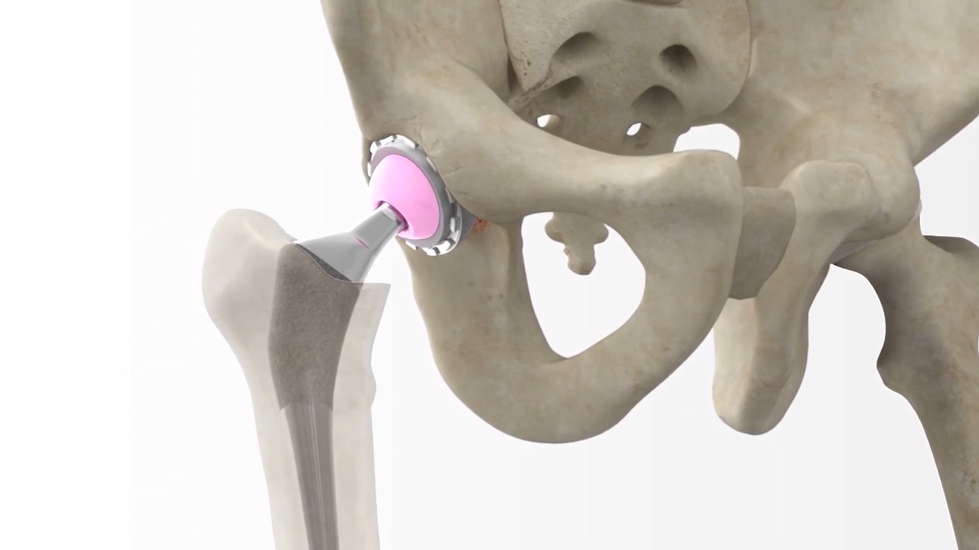 Anterior Approach Hip Patient Animation