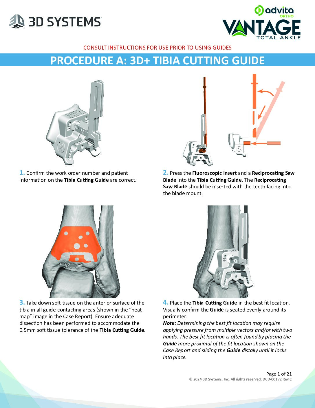 Vantage Ankle 3D Plus PSI Operative Technique