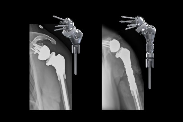 Advita Ortho Equinoxe Humeral Reconstruction Prosthesis for complex humeral bone loss and anatomic oncology application