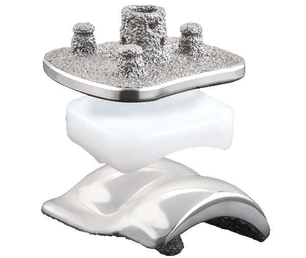 Advita Ortho Vantage Total Ankle Mobile Bearing System is designed as a comprehensive solution for total ankle arthroplasty
