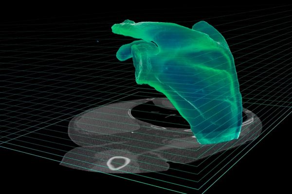 Advita Ortho Navigation Total Shoulder Arthroplasty