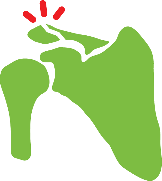 Advita Ortho Shoulder Fracture Illustration
