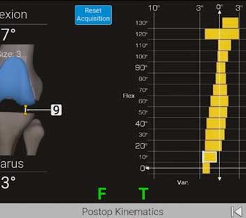 GPS Knee Newton Balancing Surgery PostOp Kinematics Screen