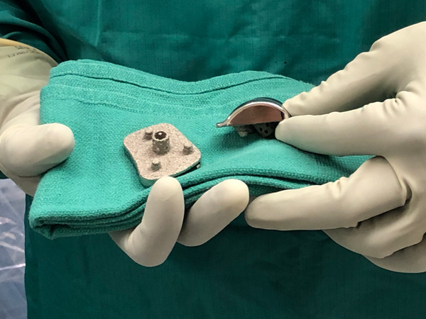 10 Year Anniversary Vantage Ankle, close up of implant