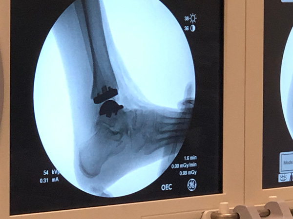 10 Year Anniversary Vantage Ankle, Xray