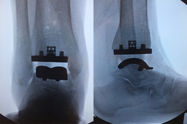 X-rays from one of the first Vantage Ankle cases performed by Mark Easley, MD